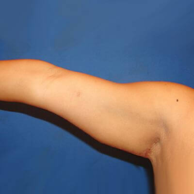 Armstraffung – Foto vorher