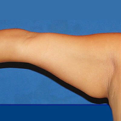 Armstraffung – Foto vorher