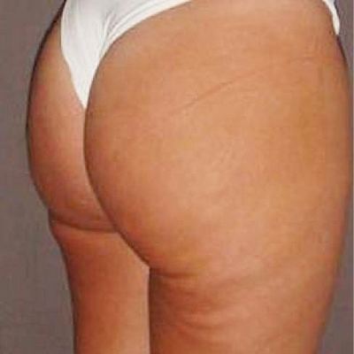Gesässformung – Foto nachher